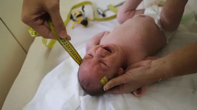 Manos midiendo la cabeza de un bebé portador del virus del Zika
