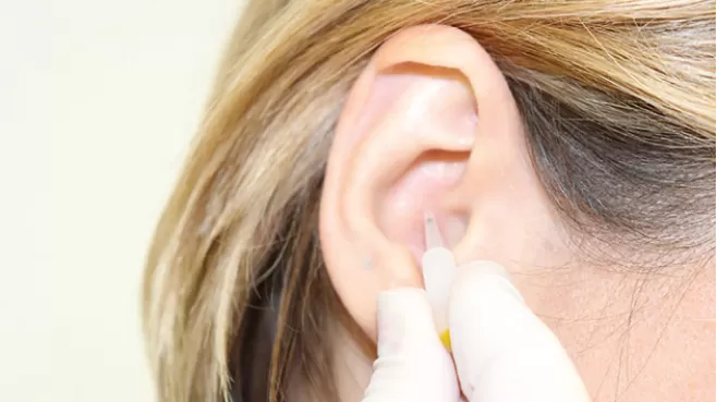 Foto de aplicación de acupuntura en la oreja